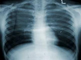 Akciğer Hipertansiyon