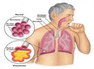 Akciğer Hipertansiyonu Hastalıkları