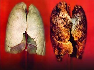 Akciğer Kanseri Belirtileri Nelerdir