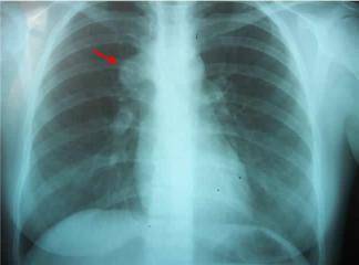 Akciğer Nodülü Nedir