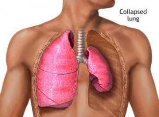 Akciğer Tansiyon Belirtileri