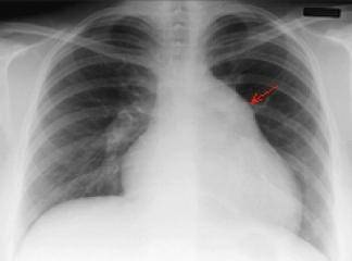Akciğer Tansiyonu Nedir