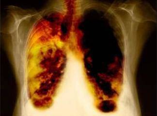 Akciğer Tümörü Nedir