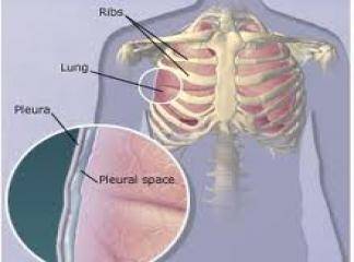 akciğer zarı iltihabı tedavisi ne kadar sürer
