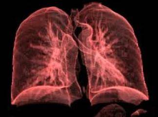 akciğerde sıvı toplanması pulmoner ödem