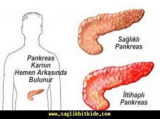 Akut Pankreatit Belirtileri