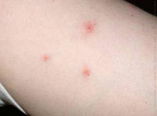 alerjik deri hastalıkları resimli