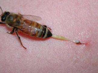 arı sokması alerjisi nasıl anlaşılır