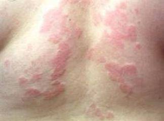 Atopik Dermatit Tedavi