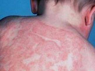 Atopik Dermatit Tedavisi