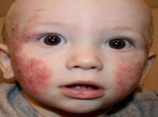 Bebeklerde Atopik Dermatit