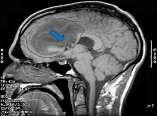 beyin tümörleri vücudun hangi bölgelerinde uyuşmaya neden olur