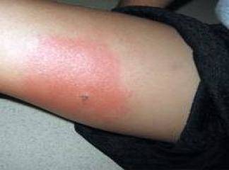 böcek ısırması alerjisi