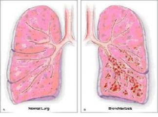 bronşektazi bitkisel tedavisi nasıldır