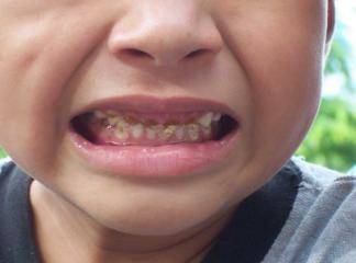 2 yaşında diş çürümesi