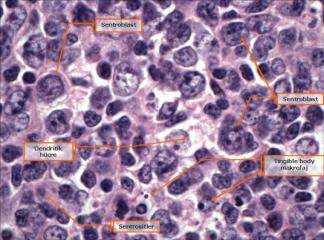 Diffüz Büyük B Hücreli lenfoma