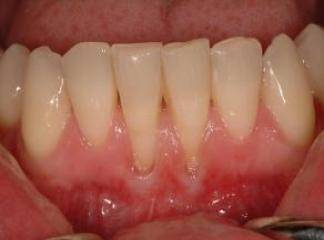 Diş Eti Hastalıkları Nasıl Tedavi Edilir