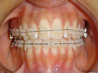 Diş teli tedavisinde hareketli uygulamalar