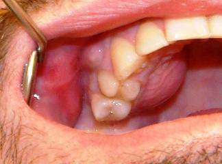 Dişeti iltihabı (Gingivitis)