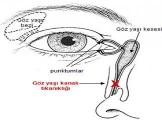 Gözyaşı Kanalı Ameliyatı