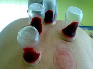 Hacamat Kupa Terapisi Kan Aldırmak