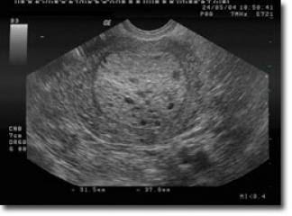 Hamilelikte Mol Hastalığı