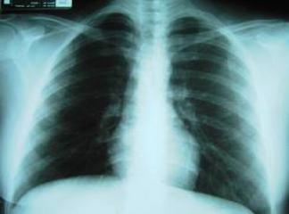 Hastalar Akciğer Grafisi