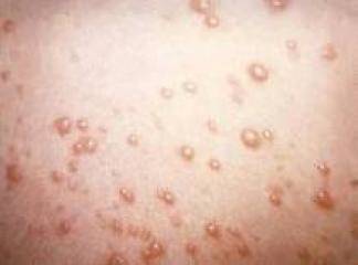 Herpes Simplex Tip2 Virüsü