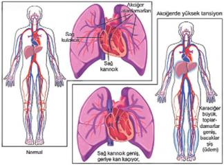 Hipertansiyon Akciğeri
