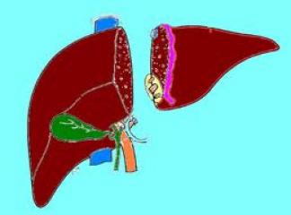 Karaciğer Nakli Nasıl Yapılır