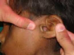 Kulak Arkası Yaraları