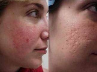 Ciltte Tavuk Derisi Gorunumu Keratosis Pilaris Nedir