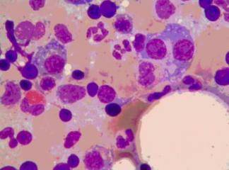 Multipl Myelom Ve İlişkili Plazma Hücre Hastalıkları