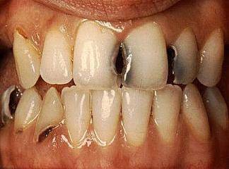 Ön Diş Çürük Tedavisi
