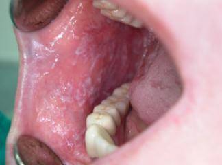 Oral Kandidiazis