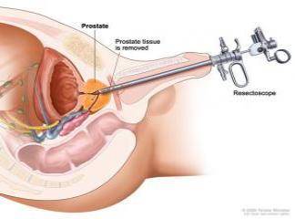 Prostat Ameliyatı Video