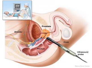 prostat kanseri tedavisi uzman tv