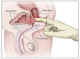 Prostat İltihabı Nedenleri