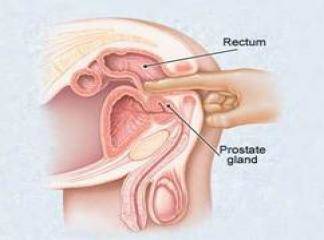 Prostat İltihabı Tedavisi Nasıldır