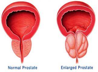 Prostatın nodüller Hiperplazisi