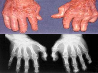 Psöriatik Artritli Hastalara Öneriler