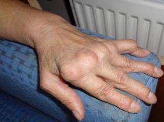 Romatoid Artrit İlaçları