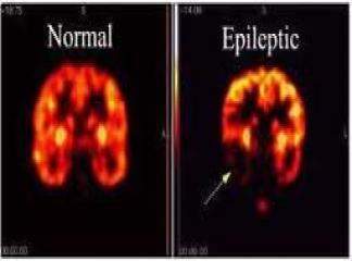sara ve epilepsi ne demek