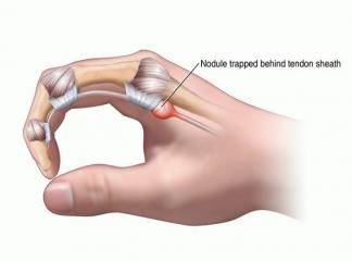 Tetik Parmak Ameliyatında Hangi Teknikler Kullanılır?