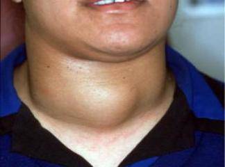 Tiroid Bezi Hastalıkları