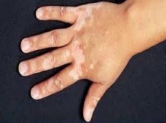 Vitiligo Tedavisinde Son Gelişmeler