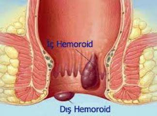 Erkan Topuz Hemoroid