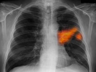Akciğer Kanseri Erken Tanı İle Anlaşılabilir Mi?