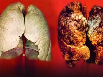 Akciğer Kanseri Tanısı Nasıl Konur?