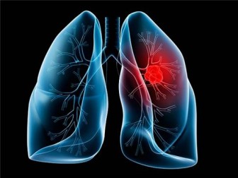 Akciğer Kanserinin Görülme Sıklığı